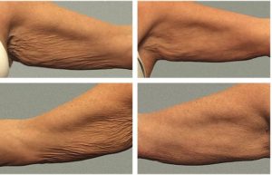Arm treatment by John Stratis MD. Pre and 3mo follow up.