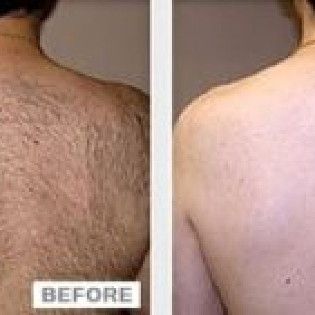 LaserFullBack-300x141