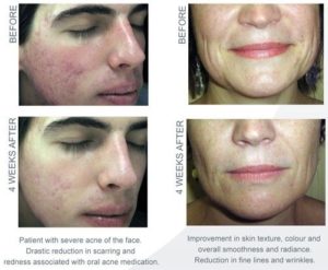 MicroMesoWeekTreatments-300x247