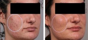 MicroNeedlingAcneMarks-300x136