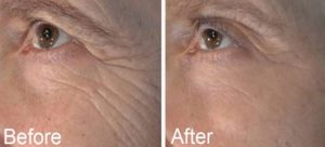 MicroNeedlingAntiWrinkle-300x136