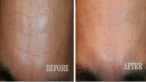 MicroNeedlingFineLines-300x169