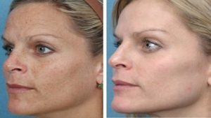 MicroNeedlingSkinBlemish-300x169