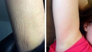 MicroNeedlingStretchMarks-300x169