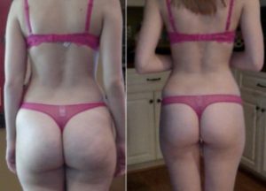 freezefat.org-before-and-after-cool-sculpting-procedure-449x324-1-300x216